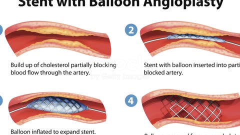 heart stent