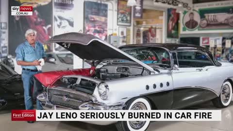 Jay Leno seriously burnt after car fire