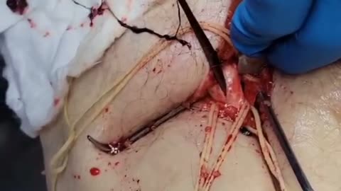 Embalmer releases footage of unbelievable blood clots from vaccinated people that died.