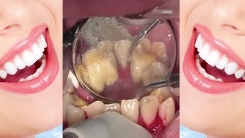 Deep Cleaning of teeth tartar