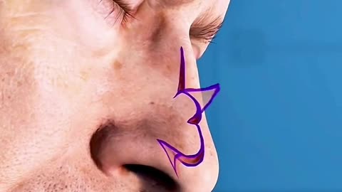 nose skin cancer removal