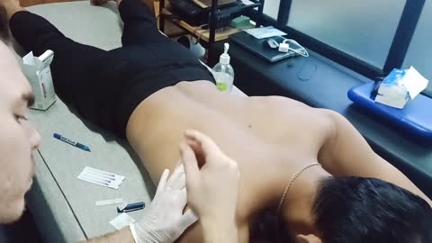 Muscle puncture shoulder pain release