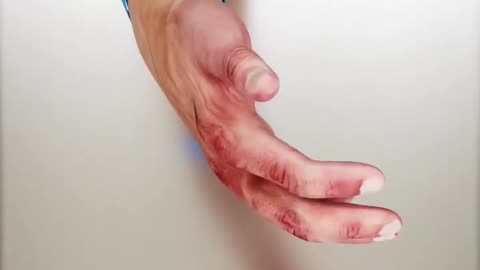 How a hand transplant works