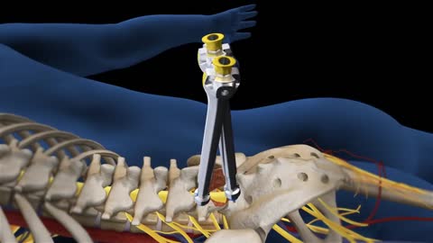 Backbone Break Repairing || Spinal Cord Break Repairing