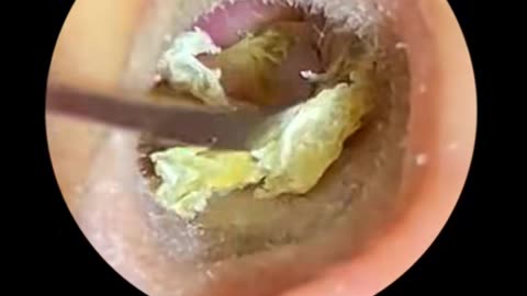 Asmr earwax