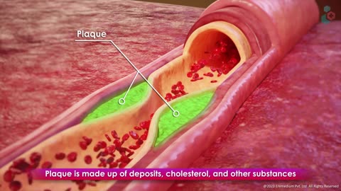 What is a Heart Attack and it's warning signs? Dos and Don'ts, Treatment Options - 3D Guide