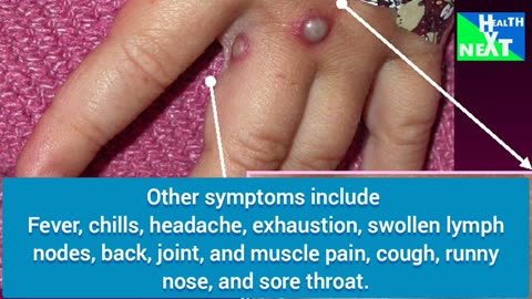 SIGNS OF MPOX THAT IS BECOMING SERIOUS TO ALL COUNTRIES /MONKEY POX