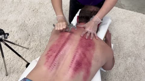 Major Explosive Release of Spinal Tension