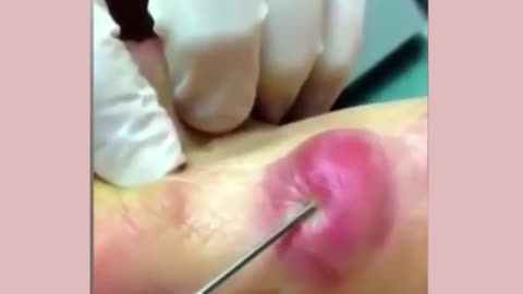 Giants Deep Blackheads, Whiteheads, Big Pimples, Hidden Acne Removal - Best Popping Videos #000035