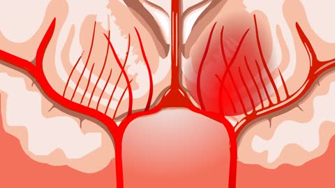 Hemorrhagic Brain Stroke Disease