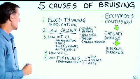 Почему появляются гематомы? Синяки на теле без причины - Доктор Берг