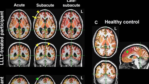 New Study: Light Therapy Enhances Brain Connectivity After Injury