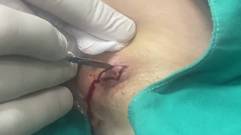 underarm abscess