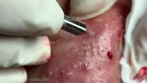 Blackheads & Milia, Big Cystic Acne Blackheads Extraction Whiteheads Removal