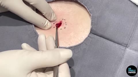 Dr Lee Opens Up Back Cyst! Dr Pimple Popper