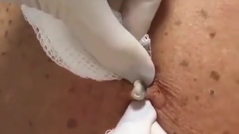 satisfying blackhead removal video