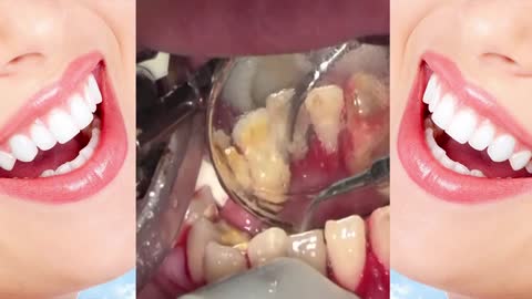 Deep Cleaning of teeth tartar ★★★★★