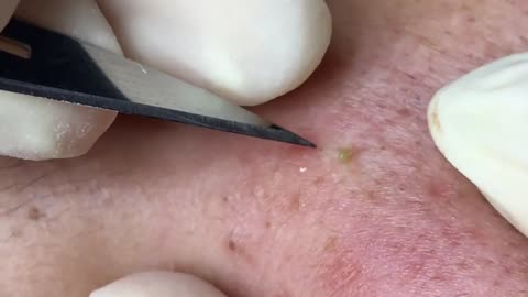 Big Blackheads Acne Removal | Acne Treatment (#3)