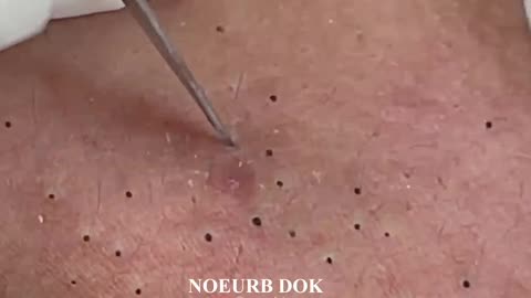 Blackhead Removal