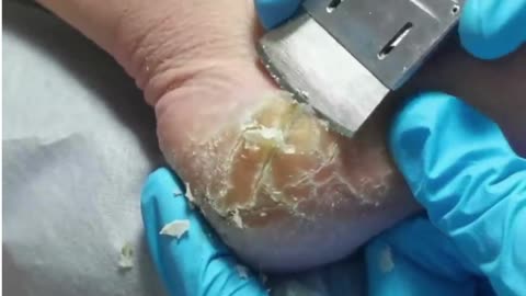 Wow! Look at cracked heels. Dead skin removal and Cracked heels treatment.