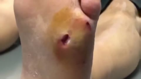 Foot Abscess Removal an explosion - Master Podology with Lexington Podiatry