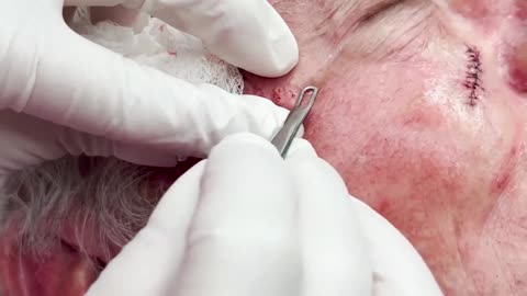 A CHEEKY BUNCH OF BLACKHEADS