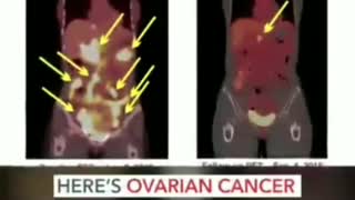 Suppression of cancer treatment