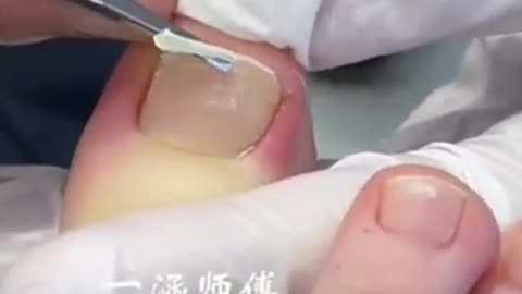 Best ingrown toenail removal treatment