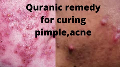 Dua to cure Pimples,Skin diseases etc.العلاج القرآني لعلاج البثور والأمراض الجلدية