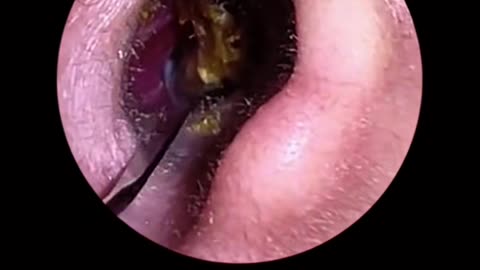 Earwax removal