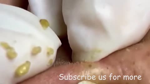 Blackhead Removal/ Acne Extraction