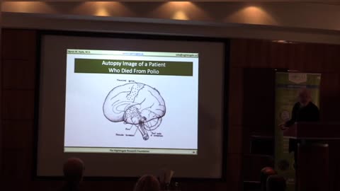 "Epidemic" Myalgic Encephalomyelitis (M.E.) vs Anterior Poliomyelitis - Byron Hyde MD