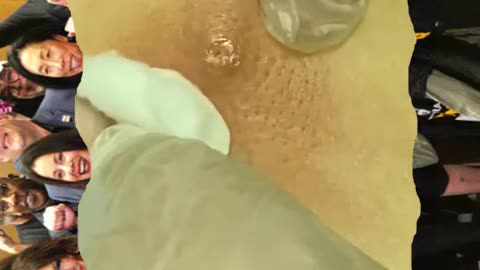 Pimple popping and blackhead