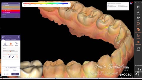 #design #naildesign #dental #dentaldesign #exocadexpert