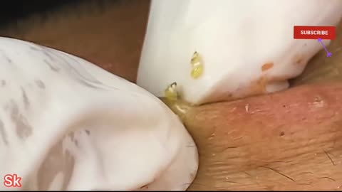 Satisfying Pimple popper and blackheads Removal