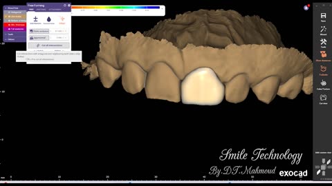 #design #naildesign #dental #dentaldesign #exocadexpert