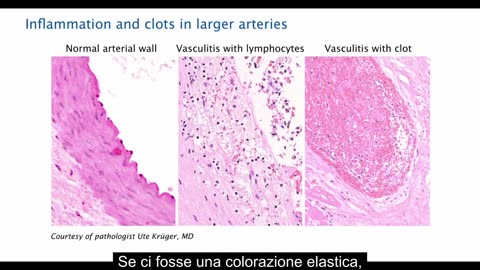 Intervista finale al professor Arne Burkhardt: Rivelare i gravi pericoli dei vaccini a mRNA