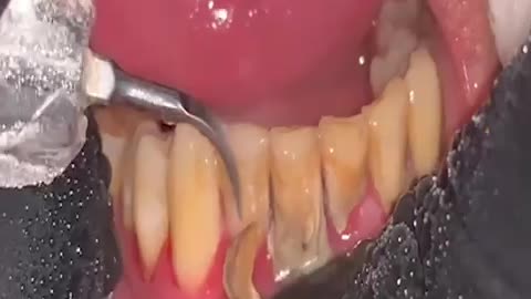 Root Canal Treatment 🙀🙀 #dental