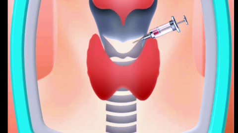 Vocal cord Reconstruction😷😷😷