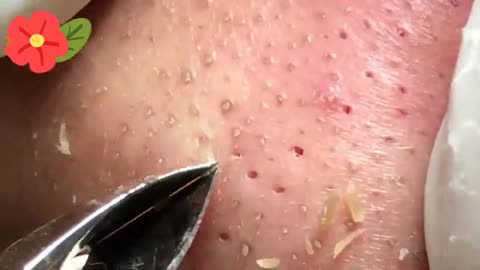 Satisfying Blackhead Removal