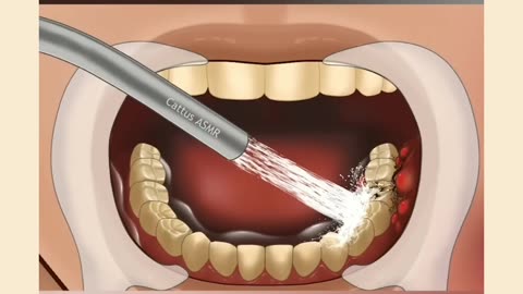 ASMR Treatment of Severe Tooth Decay