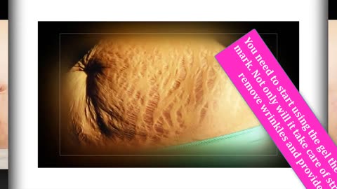 Get Rid of Pregnancy Stretch Marks Just in 2 Weeks _ Remove Stretch Marks Fast and Easily