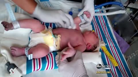 'Miracle Baby' Born Without Most of His Brain Defying Odds | ABC News