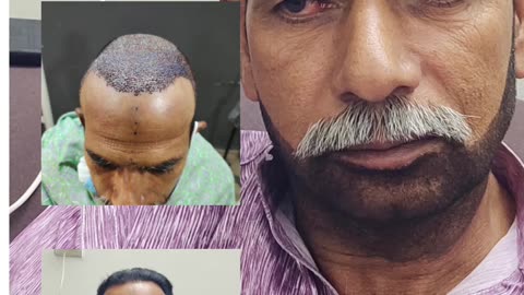 Fue Hair transplant results Karachi