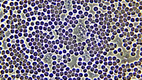 White blood cell phagocytes moving in blood, with red blood cell hemolysis.