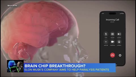 NEURALINK BRAIN CHIP TRANSPLANT! THIS ISN'T REALLY THE 1ST!