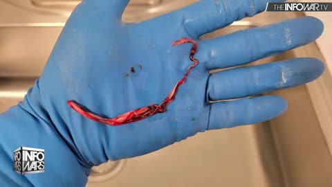 Mortician Finds Massive Hand-Sized Clots In Cadavers After Vax