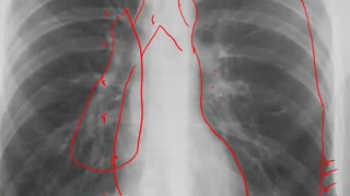 Left Pneumothorax CXR