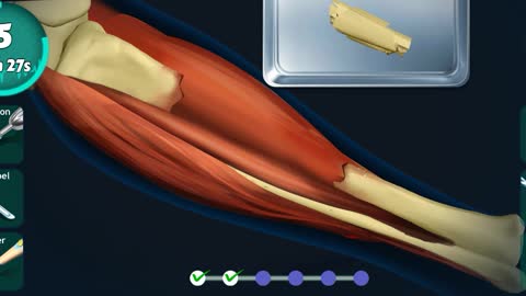 Leg fracture treatment animation