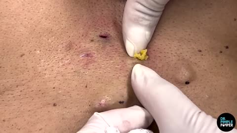 A Belly Full Of Steatocystomas! Dr Pimple Popper Mines a Patient's Stomach - Part 1